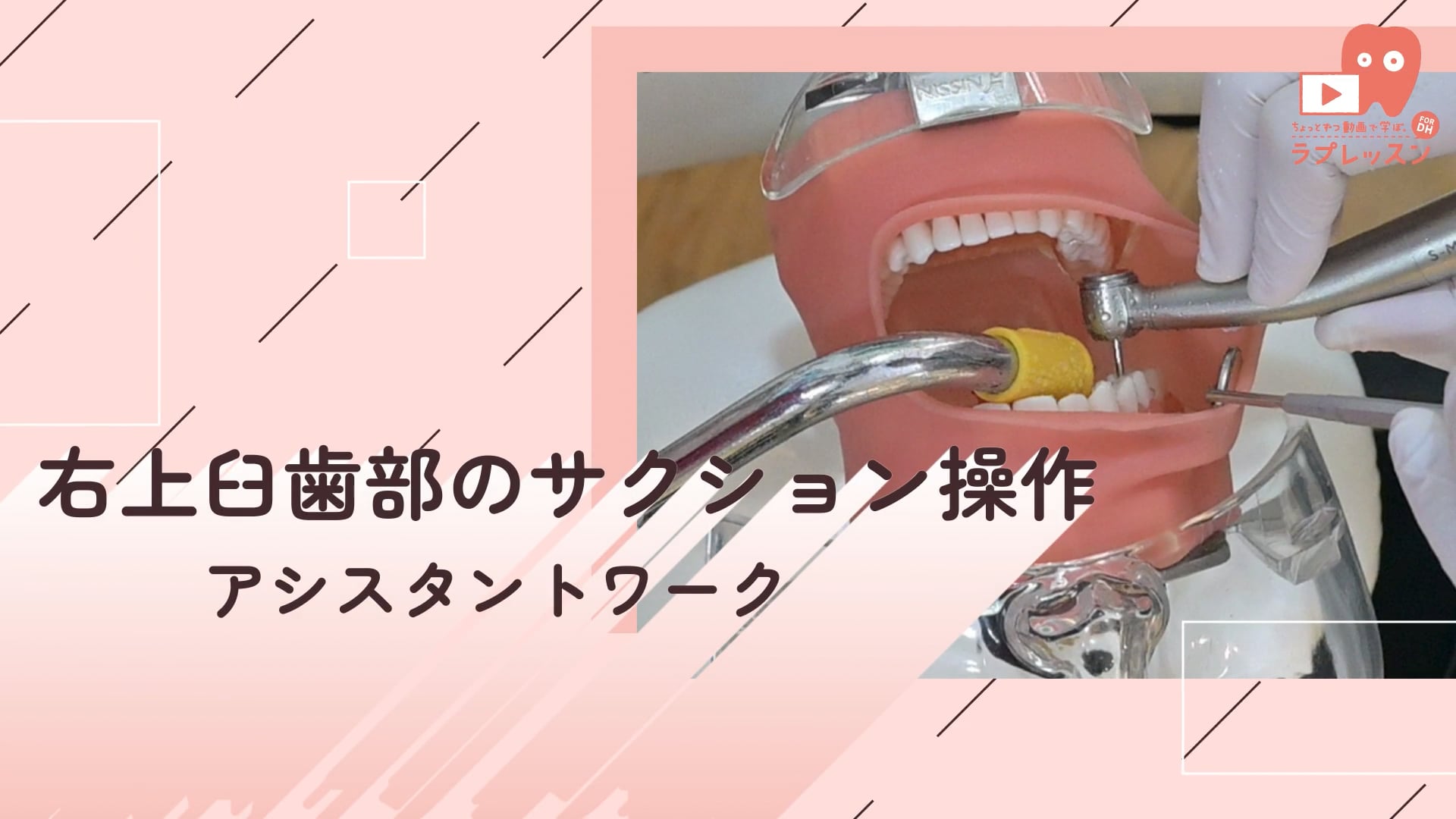 02.右上臼歯部のサクション操作