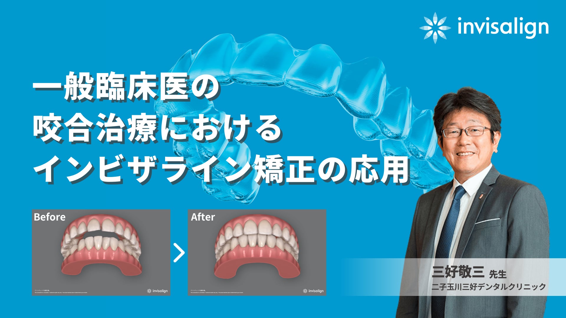 一般臨床医の咬合治療におけるインビザライン矯正の応用