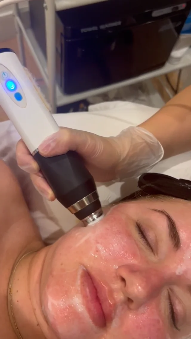 Pros Of Sublime Skin Tightening - Lipstick Empire LaserSpa