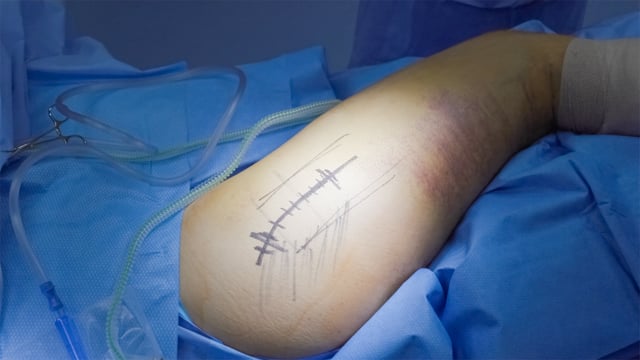 Open Repair of a Gluteus Maximus Tendon Rupture