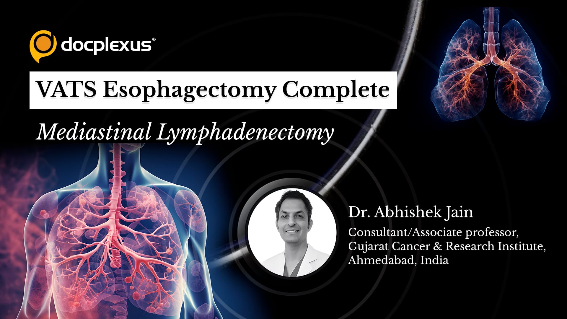 VATS Esophagectomy Complete Mediastinal Lymphadenectomy