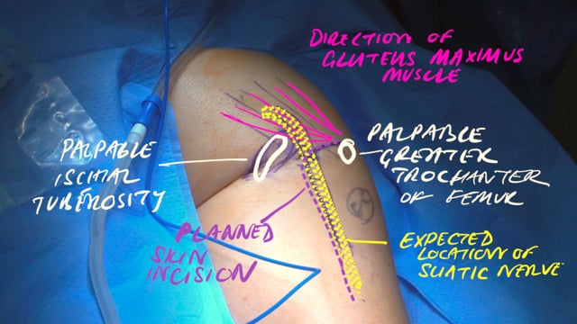 Neurolysis of the Sciatic Nerve with Removal of Suture at the Ischial Tuberosity