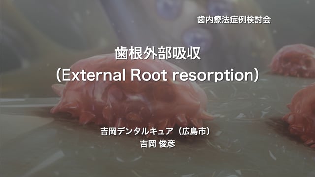 歯根外部吸収（external root resorption）｜吉岡俊彦先生(Topics)