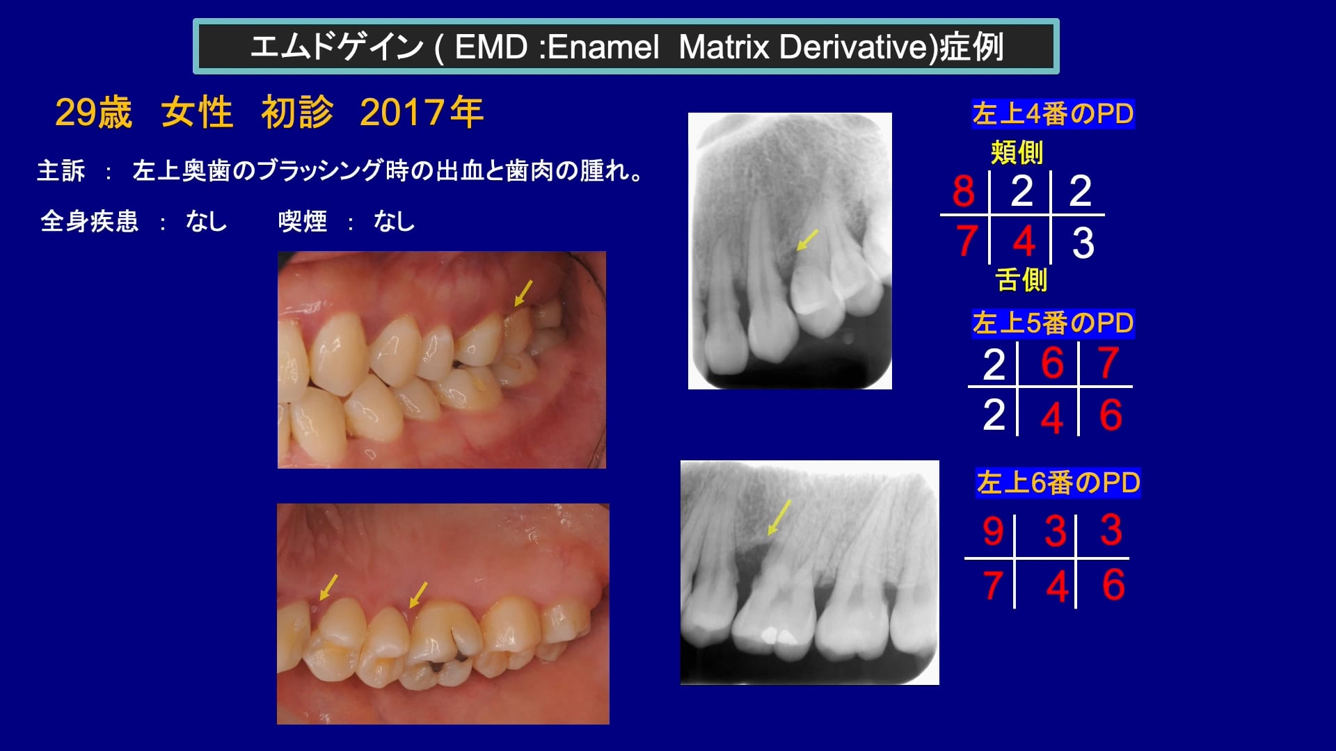 臨床知見録_エムドゲイン_エムドゲインを使用したMISTの症例