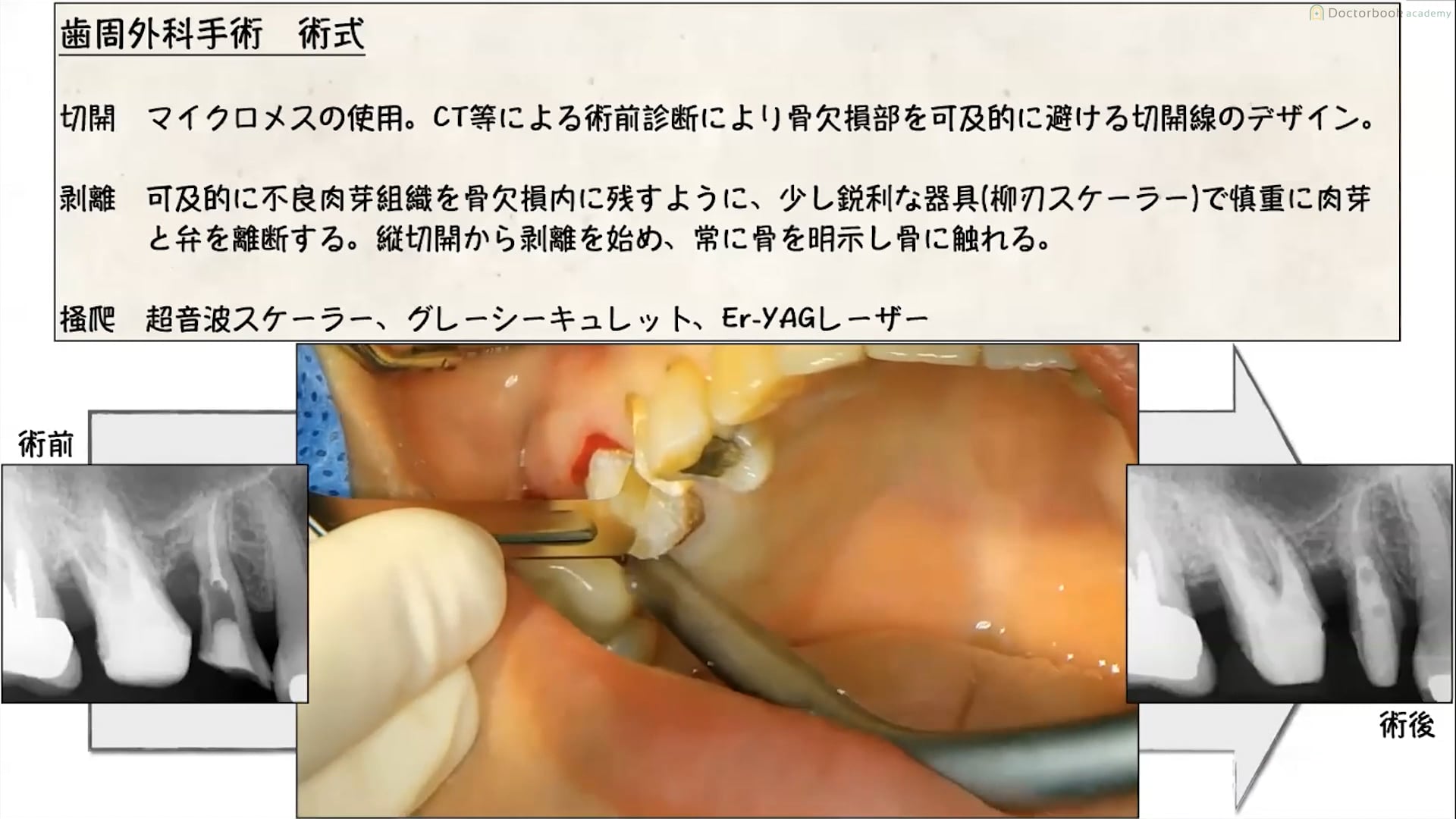 臨床知見録_エムドゲイン_歯周外科手術の術式
