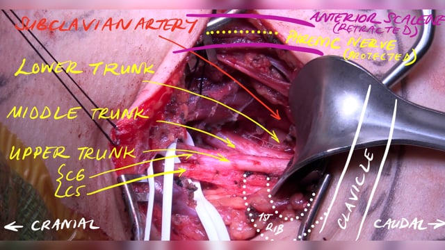 Supraclavicular Brachial Plexus Neurolysis