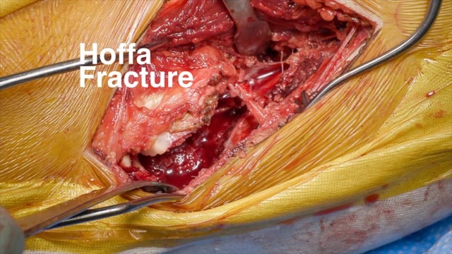Repair of Partial Articular (Hoffa) Fracture of the Distal Femur Using a Posterolateral Approach