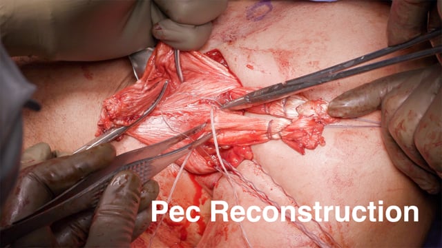 Pectoralis Major Tendon Reconstruction with Multiple Achilles Tendon Allografts