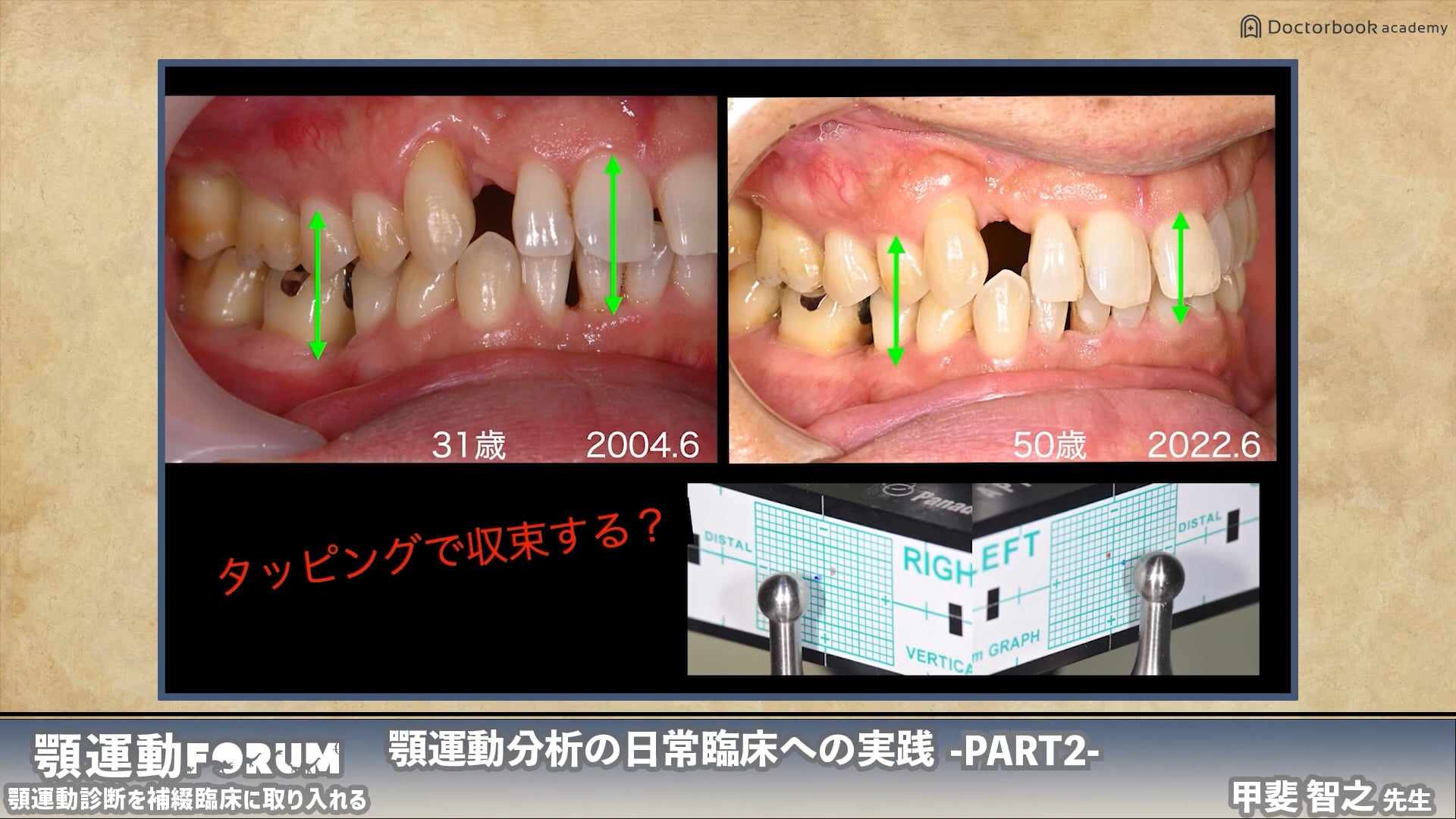 顎運動の臨床応用〜中心位把握と咬合治療へのアプローチ〜丨甲斐 智之先生