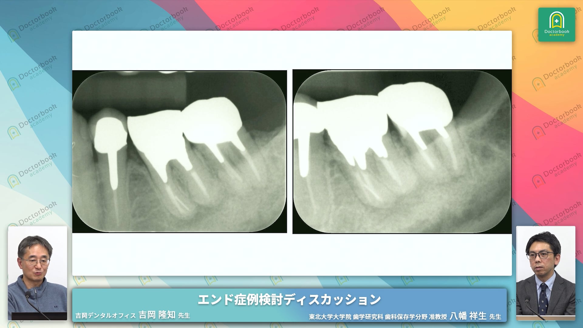 全身疾患が根尖病巣や根管治療に及ぼす影響丨Endo Case Discussion #7