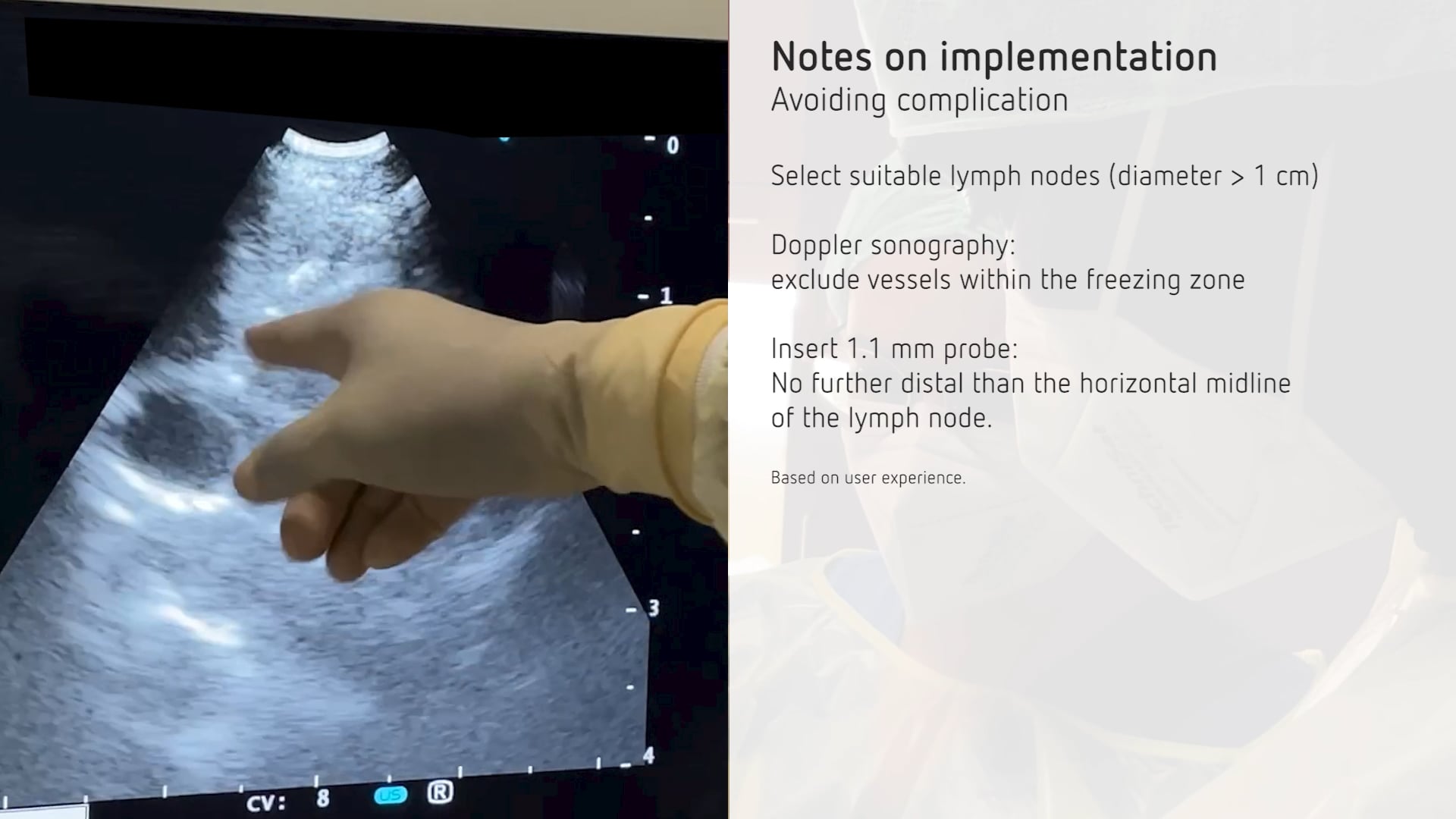 EBUS-guided mediastinal cryobiopsy of a lymph node