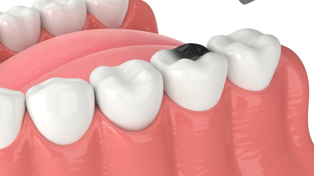 Tooth Extraction
