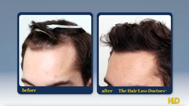 Best hair transplant hot sale doctors in nj