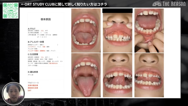 第12回 歯並びに加えて睡眠時の症状を主訴とした症例