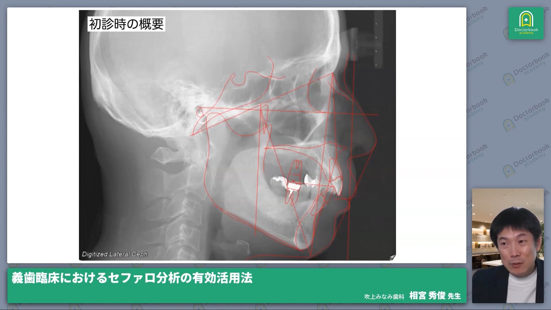 臨床知見録_診査・診断_義歯臨床にセファロを用いるメリット