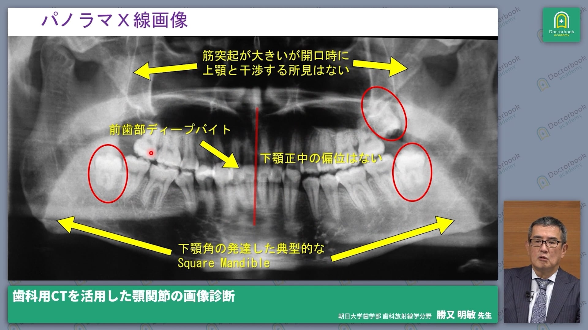 臨床知見録_診査・診断_顎関節症の診断ポイント