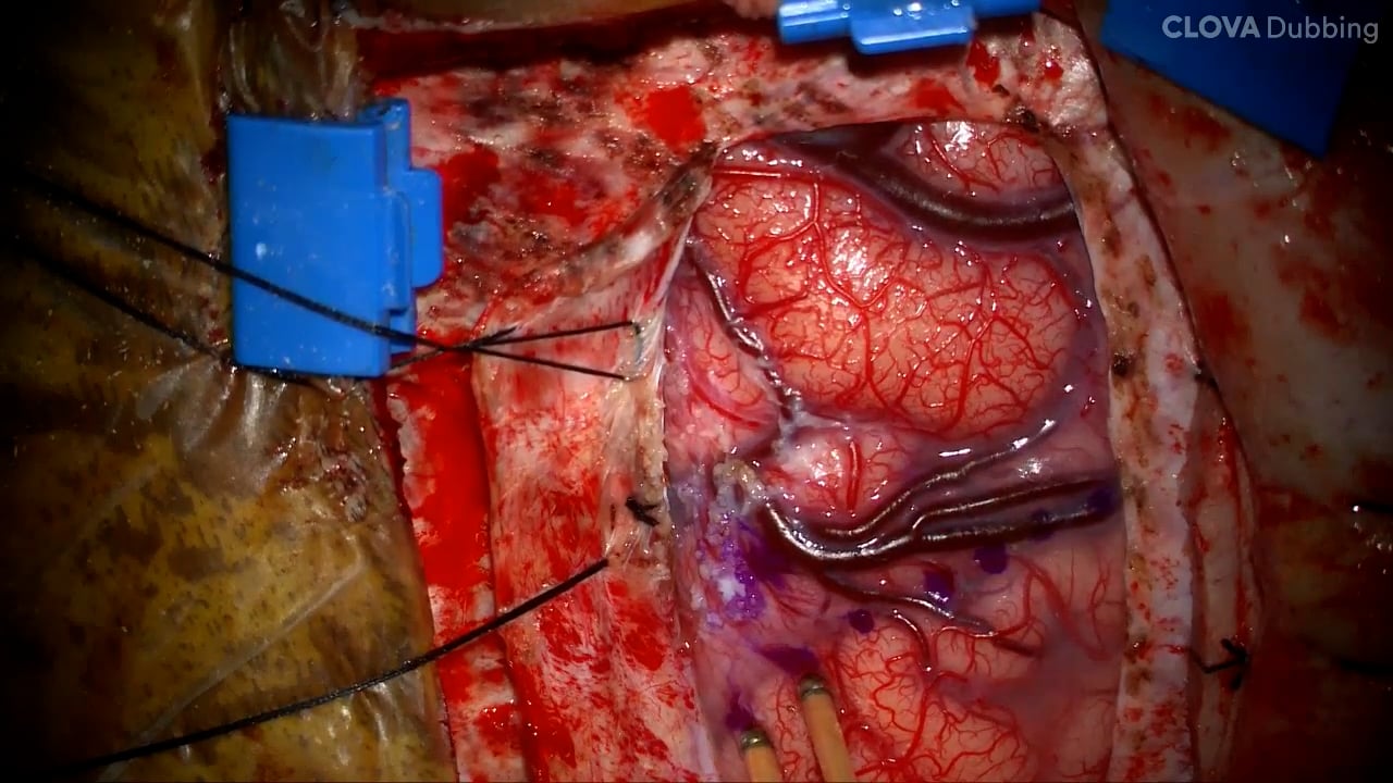 Surgical Resection of a Cingulate Gyrus Tumor (using the SSEP phase reversal technique)