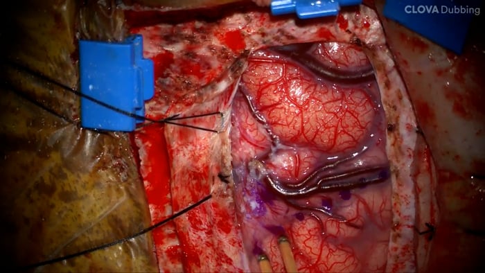 Surgical Resection of a Cingulate Gyrus Tumor (using the SSEP phase reversal technique)