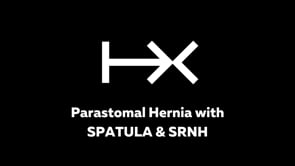 Parastomal hernia with SPATULA & SRNH