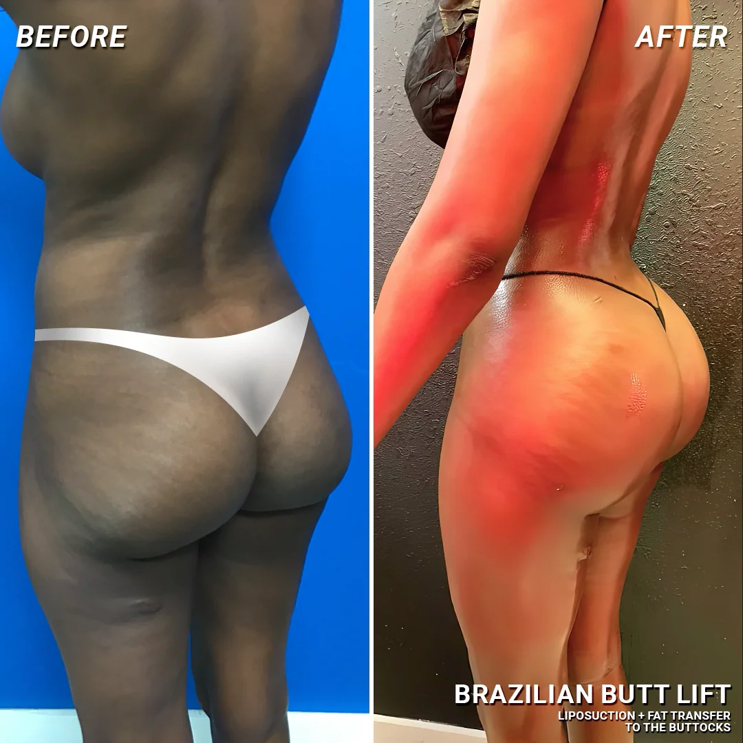 tirzepatide after bbl Before & After Brazilian Butt Lift with Dr. Drew Kreegel #1