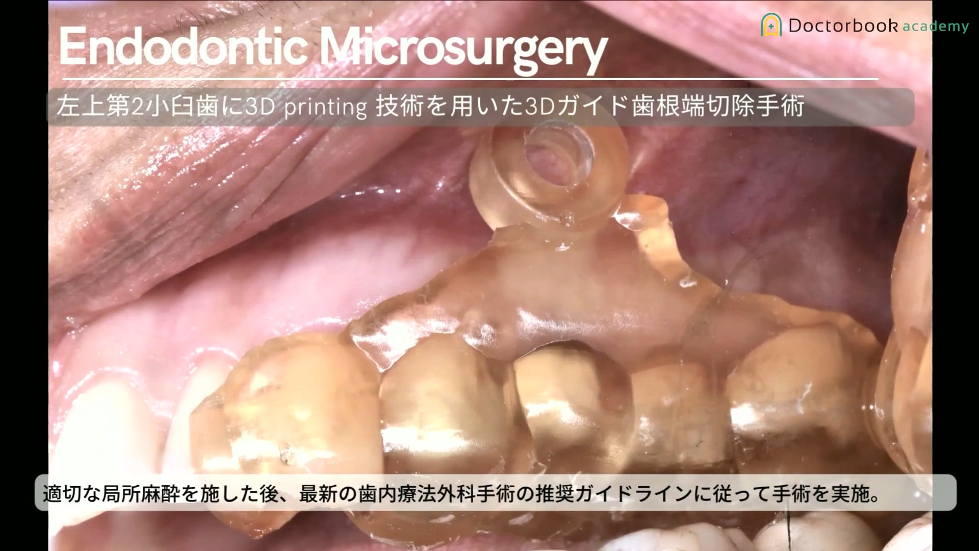 臨床知見録_XR技術_3Dガイドテンプレートを用いた症例