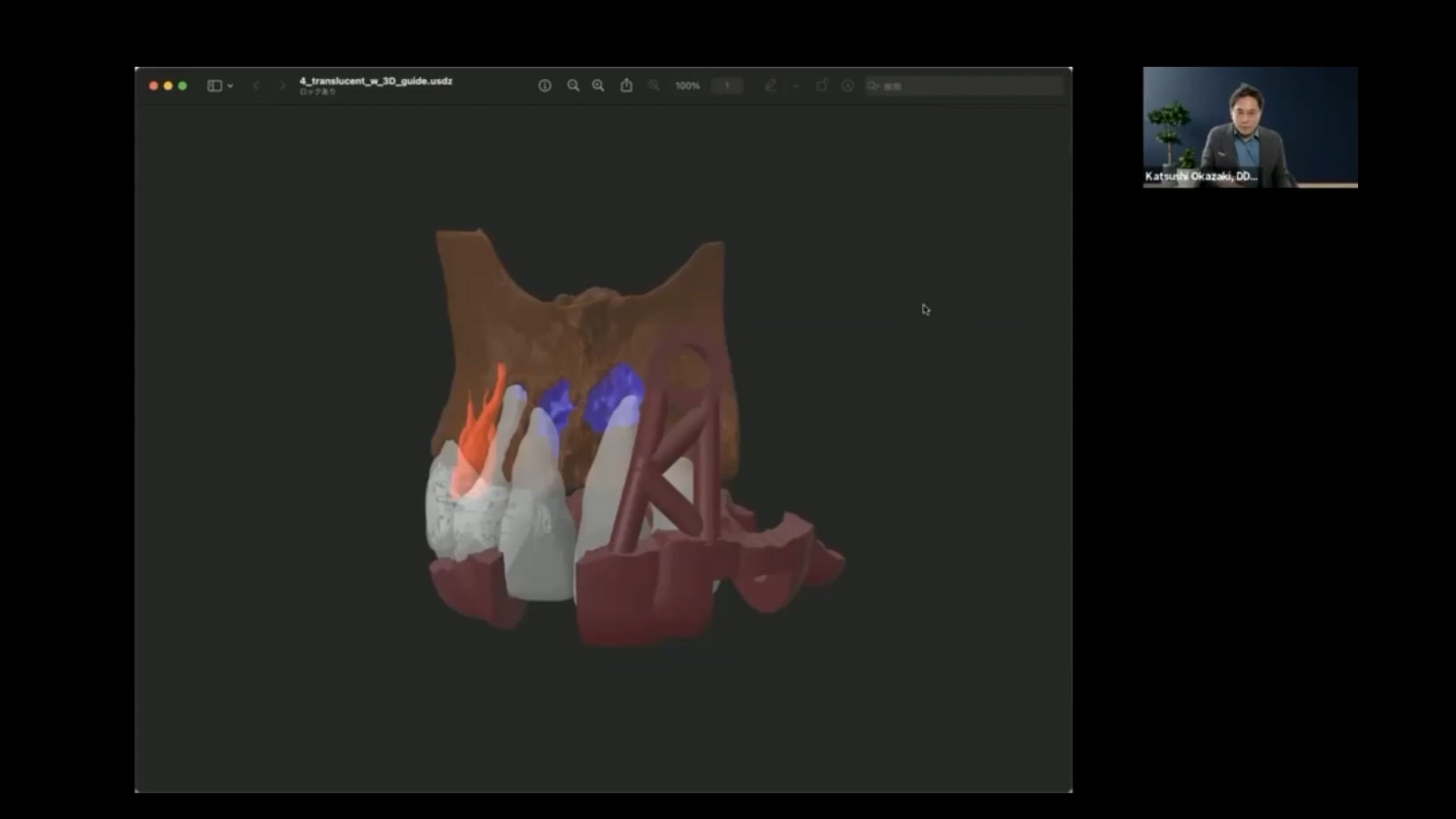 臨床知見録_XR技術_桶状根をVRで見た映像