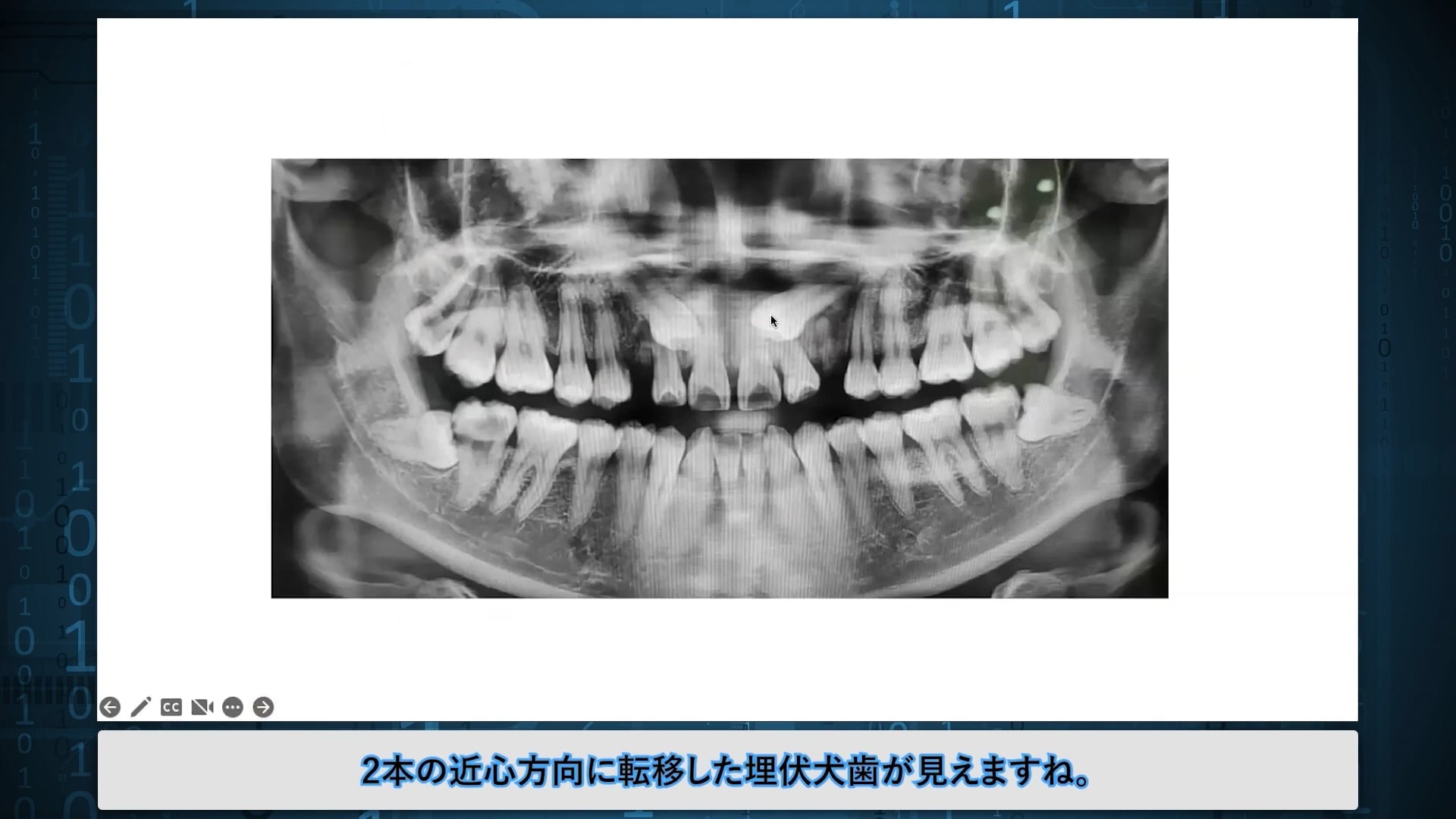 臨床知見録_XR技術_セメント質剥離の症例について