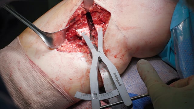 High Tibial Osteotomy with Patient Specific Instrumentation