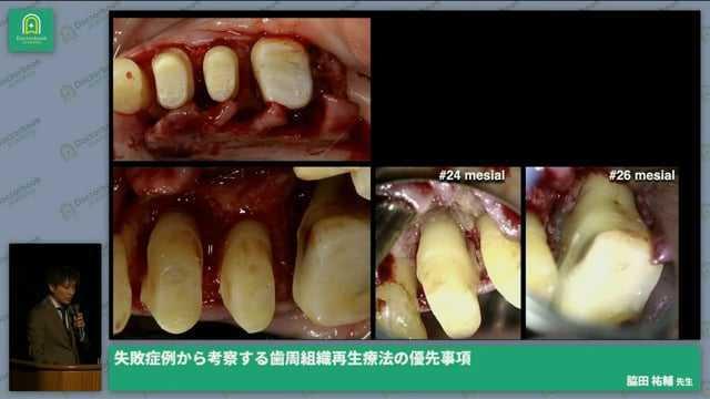 歯周組織再生療法　〜治療戦略から広がるその可能性〜│脇田 祐輔先生