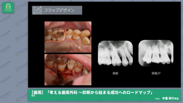 総括　〜考える歯周外科〜│中富 研介先生