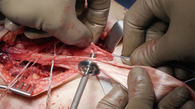 MCL Repair with Allograft Augmentation in Multiligamentous Knee Reconstruction