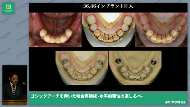 ゴシックアーチを用いた咬合再構成 -水平的顎位の道しるべ-│深町 太伊地先生