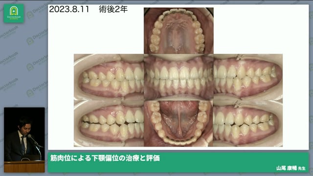 筋肉位による下顎偏位の治療と評価│山尾 康暢先生