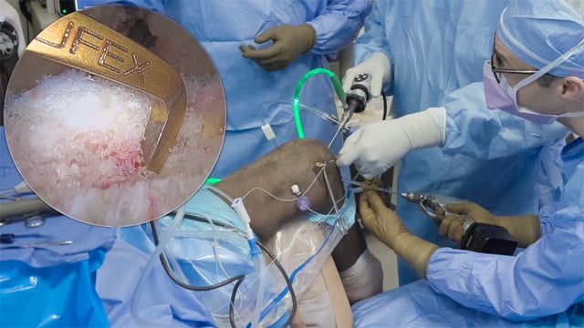 Multiligamentous Knee Injury with Biceps Femoris Avulsion and Common Peroneal Nerve Injury: ACL, PCL, PLC Reconstruction
