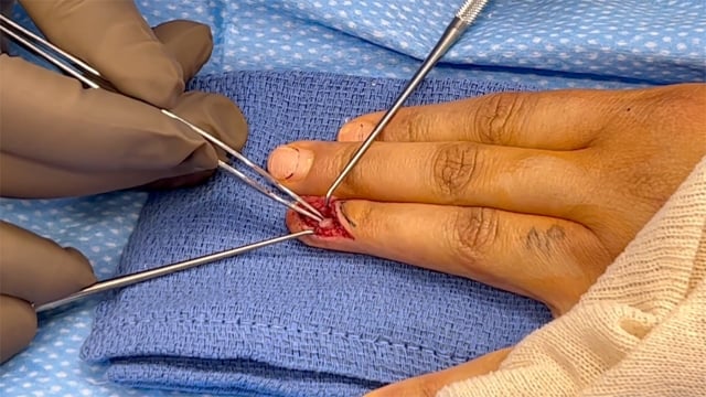 Excision of Glomus Tumor Using the Nail-sparing Approach
