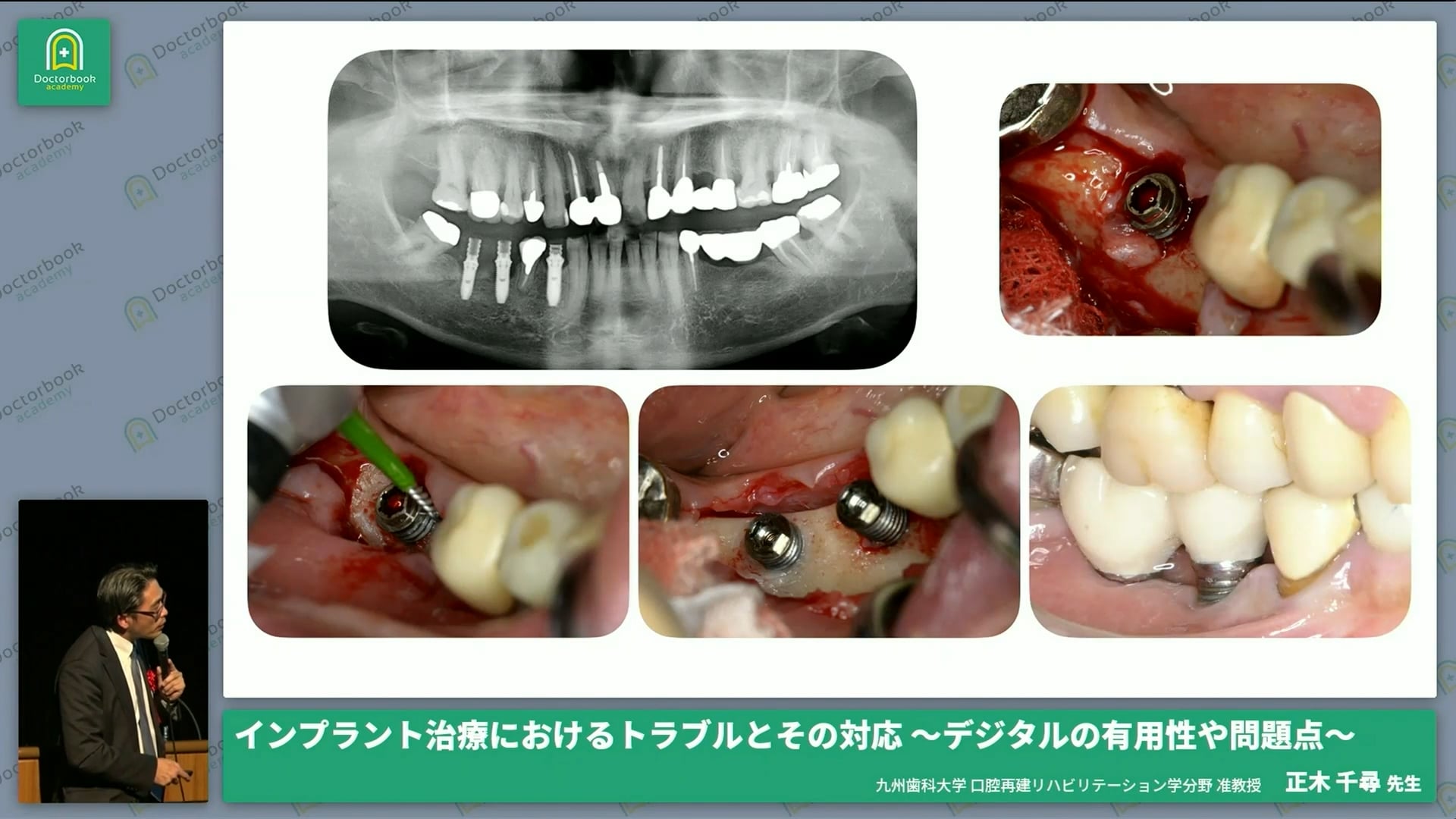 インプラント治療に対するトラブルとその対応 〜デジタルの有用性や問題点〜丨15th STEP ANNUAL MEETING with R & PABC 招待講演