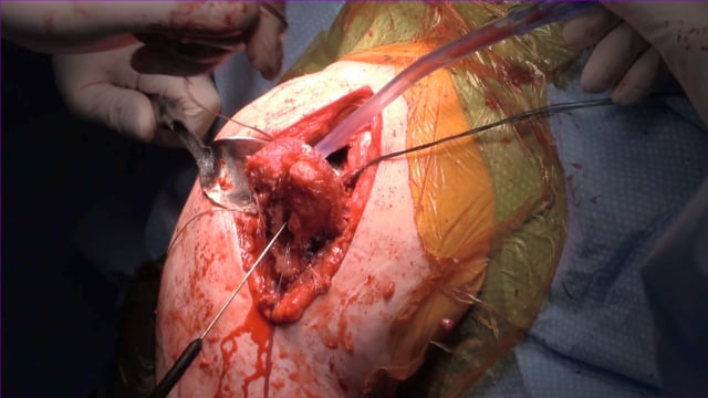 The Modified L’Episcopo Procedure with Reverse Total Shoulder Arthroplasty