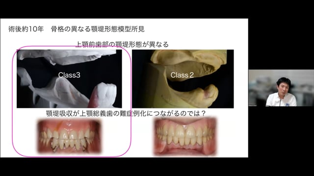 義歯治療の長期的安定を目指して 前半┃相宮 秀俊先生