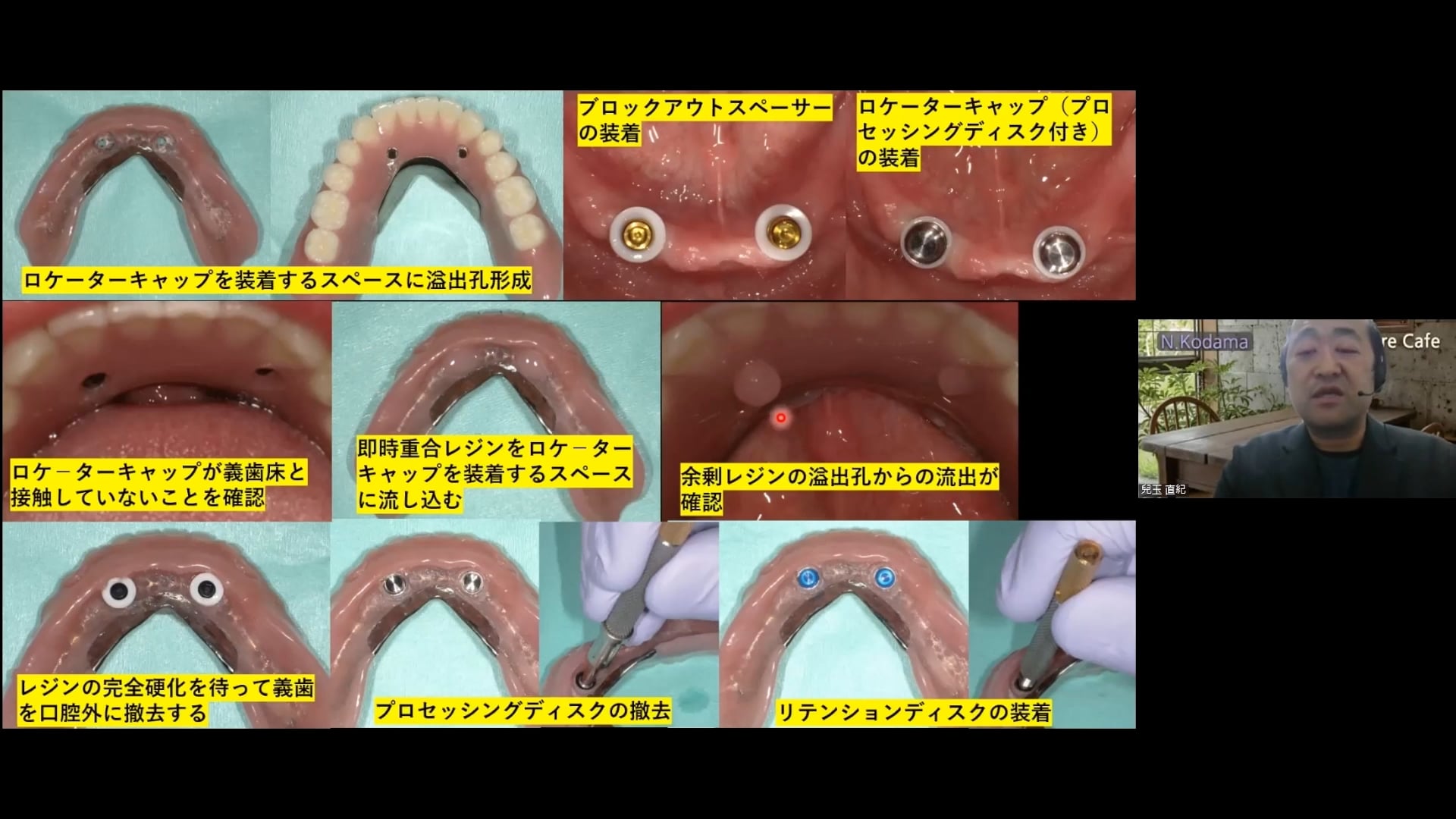 ロケーターアタッチメントについて┃兒玉 直紀先生