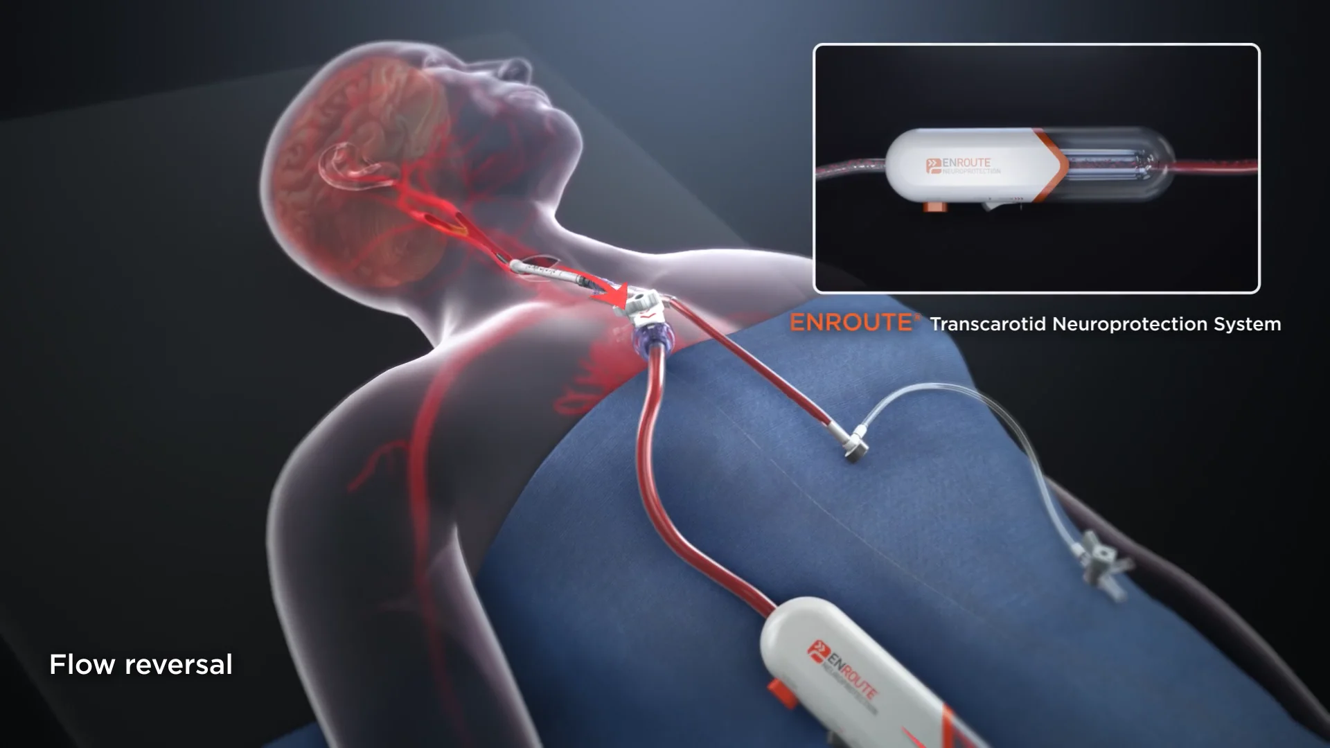 ENROUTE® Transcarotid Neuroprotection System | Silk Road Medical ENROUTE® Transcarotid Neuroprotection System | Silk Road Medical