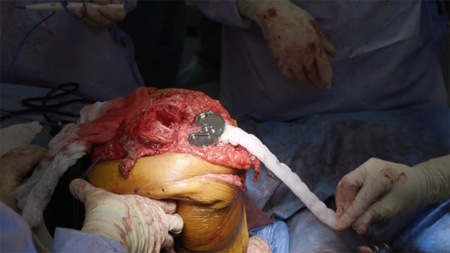 Simultaneous Primary Total Knee Arthroplasty and Extensor Mechanism Reconstruction Using Polypropylene Mesh