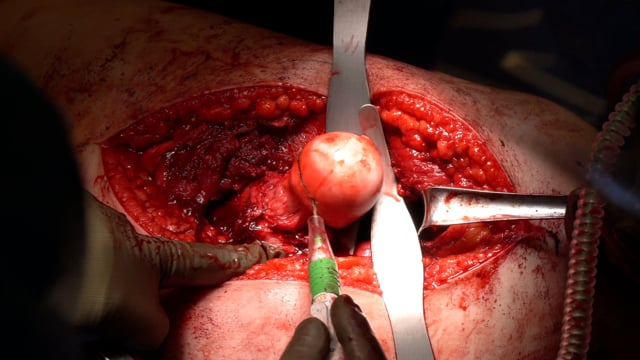 Surgical Hip Dislocation for Synovial Chondromatosis