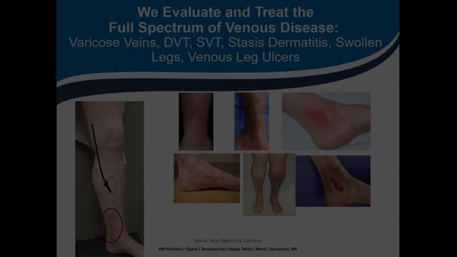 Vein Procedures to Help with Wound Healing Jason Gilster, MD FACS