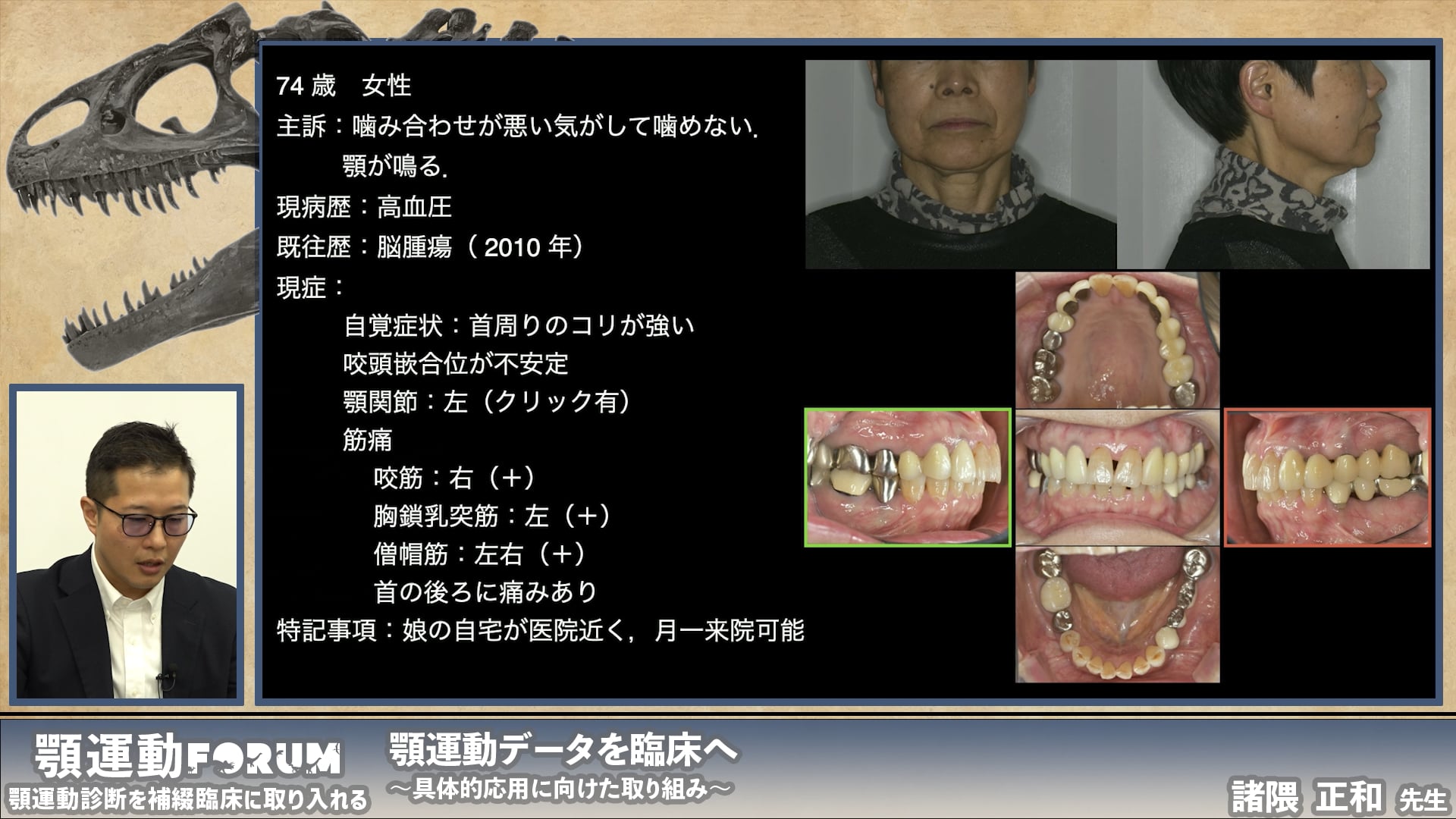 顎運動データを応用し咬合再構成を行った症例の解説〜実症例に学ぶ顎運動分析〜 #2