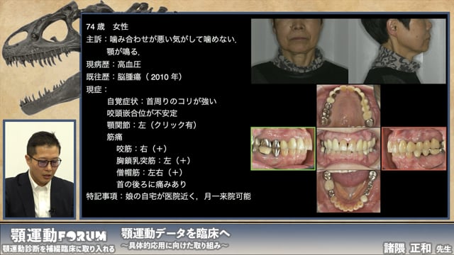 顎運動データを応用し咬合再構成を行った症例の解説〜実症例に学ぶ顎運動分析〜 #2