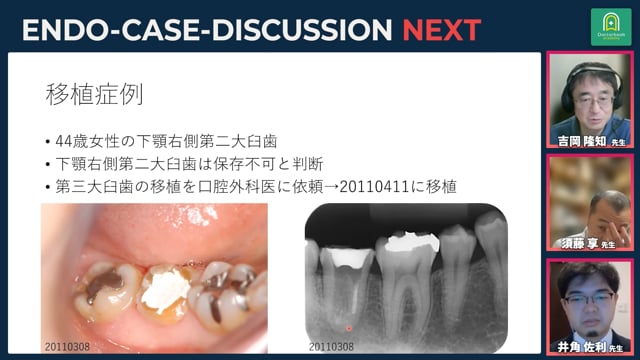 移植歯の経過 - 移植後、歯頚部外部吸収が見られた症例丨吉岡隆知先生の症例解説_#2