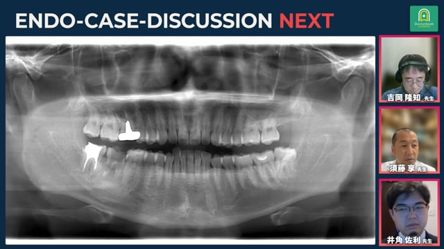移植症例 - 問題無く10年以上経過したケース・歯根吸収が起きたケース丨須藤享先生の症例解説_#3