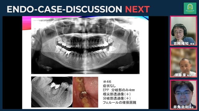 自家歯牙移植を行った症例の検討｜吉岡隆知先生・須藤享先生・井角佐利先生_#4