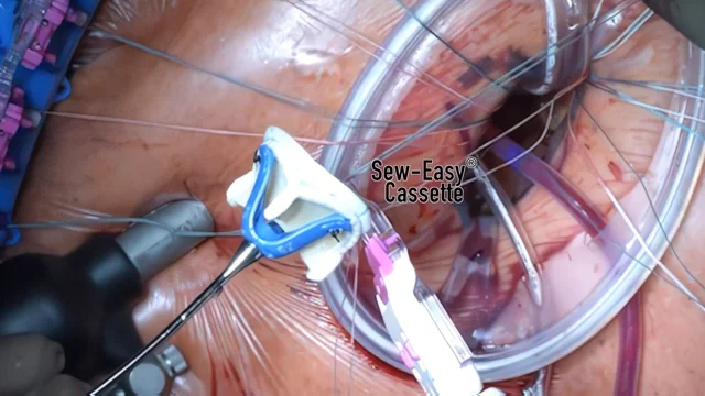 Interventional Radiology Procedures: Chest Port Placement - Stepwards