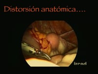 02 Anatomia Laparoscopica Endometriose Profunda - Jaime Albornoz